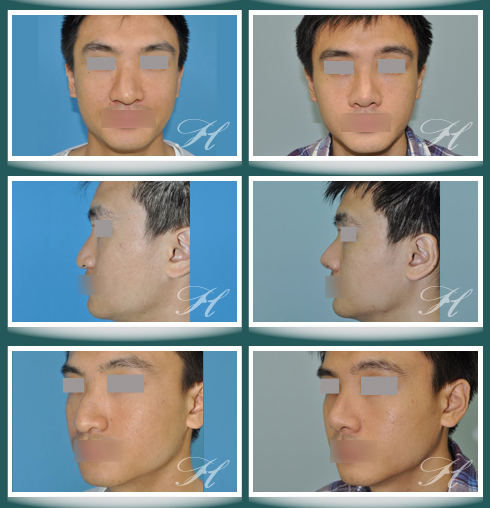 蕭彥彰醫師鼻整型(隆鼻)中心:: 醫學新知- 自體肋軟骨隆鼻及鼻整形手術 